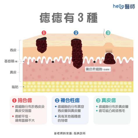 虎口突然長痣|痣形成的原因？痣長毛、痣變多變大是痣病變？5招判別